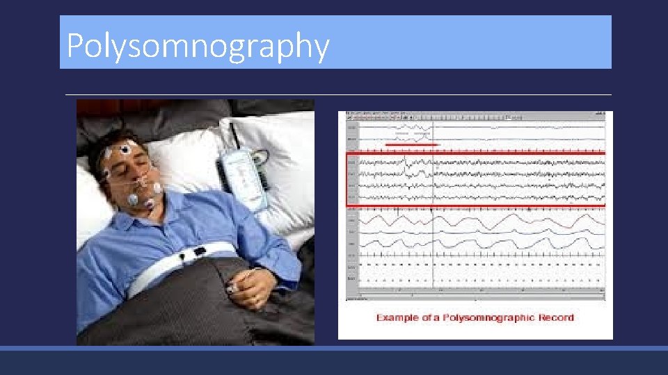 Polysomnography 