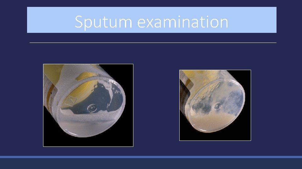 Sputum examination 