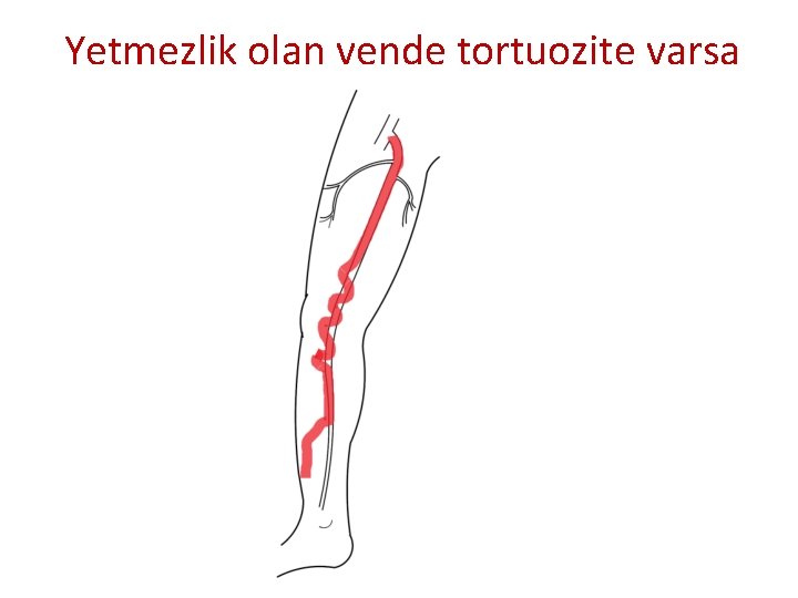 Yetmezlik olan vende tortuozite varsa Yetmezlik olan vende tortuozite varsa