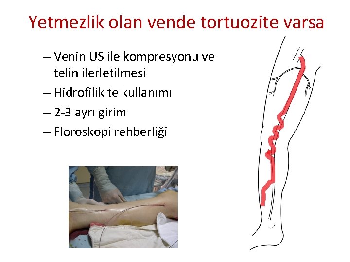 Yetmezlik olan vende tortuozite varsa – Venin US ile kompresyonu ve telin ilerletilmesi – Yetmezlik olan vende tortuozite varsa – Venin US ile kompresyonu ve telin ilerletilmesi –