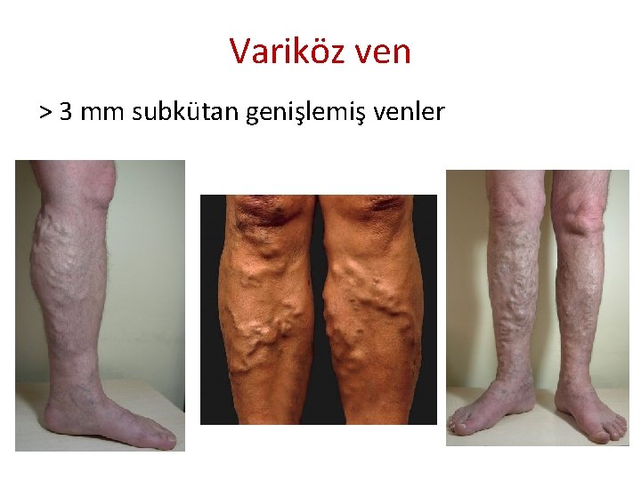 Variköz ven > 3 mm subkütan genişlemiş venler Variköz ven > 3 mm subkütan genişlemiş venler