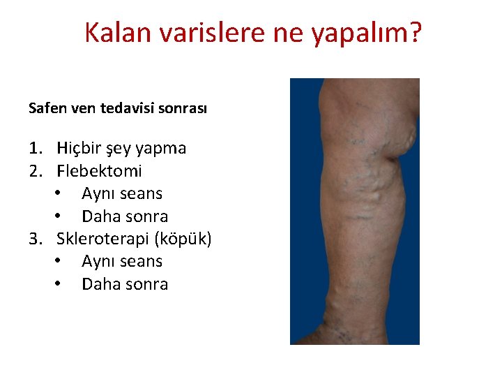 Kalan varislere ne yapalım? Safen ven tedavisi sonrası 1. Hiçbir şey yapma 2. Flebektomi Kalan varislere ne yapalım? Safen ven tedavisi sonrası 1. Hiçbir şey yapma 2. Flebektomi