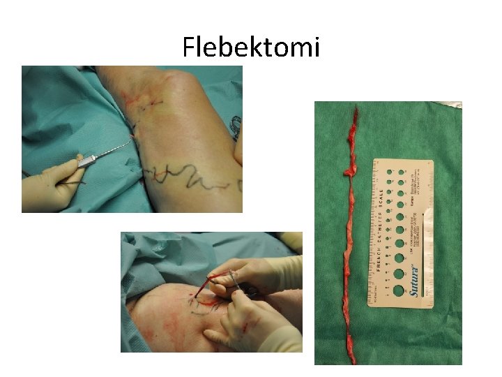 Flebektomi Flebektomi