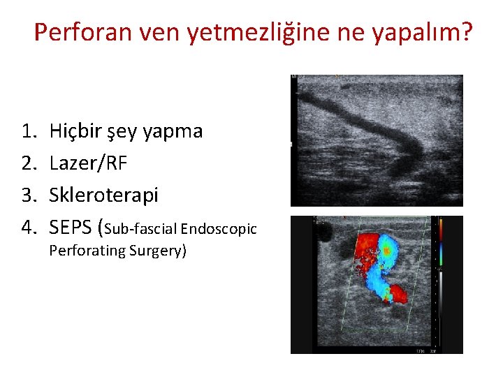 Perforan ven yetmezliğine ne yapalım? 1. 2. 3. 4. Hiçbir şey yapma Lazer/RF Skleroterapi Perforan ven yetmezliğine ne yapalım? 1. 2. 3. 4. Hiçbir şey yapma Lazer/RF Skleroterapi