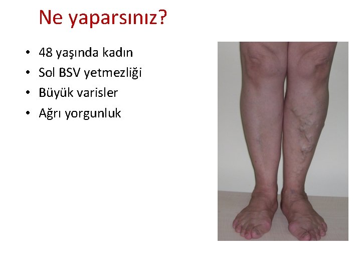 Ne yaparsınız? • • 48 yaşında kadın Sol BSV yetmezliği Büyük varisler Ağrı yorgunluk Ne yaparsınız? • • 48 yaşında kadın Sol BSV yetmezliği Büyük varisler Ağrı yorgunluk