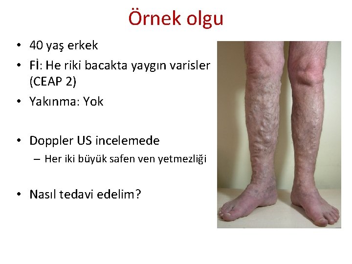Örnek olgu • 40 yaş erkek • Fİ: He riki bacakta yaygın varisler (CEAP Örnek olgu • 40 yaş erkek • Fİ: He riki bacakta yaygın varisler (CEAP