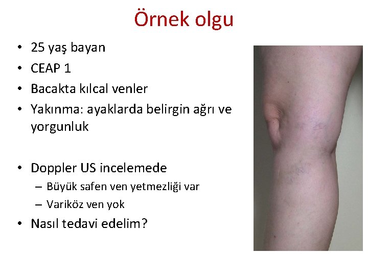 Örnek olgu • • 25 yaş bayan CEAP 1 Bacakta kılcal venler Yakınma: ayaklarda Örnek olgu • • 25 yaş bayan CEAP 1 Bacakta kılcal venler Yakınma: ayaklarda