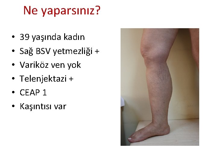 Ne yaparsınız? • • • 39 yaşında kadın Sağ BSV yetmezliği + Variköz ven Ne yaparsınız? • • • 39 yaşında kadın Sağ BSV yetmezliği + Variköz ven