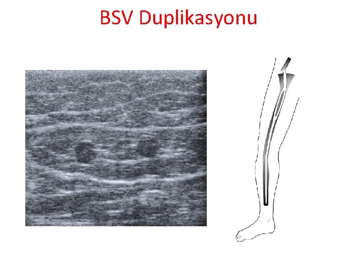 BSV Duplikasyonu BSV Duplikasyonu