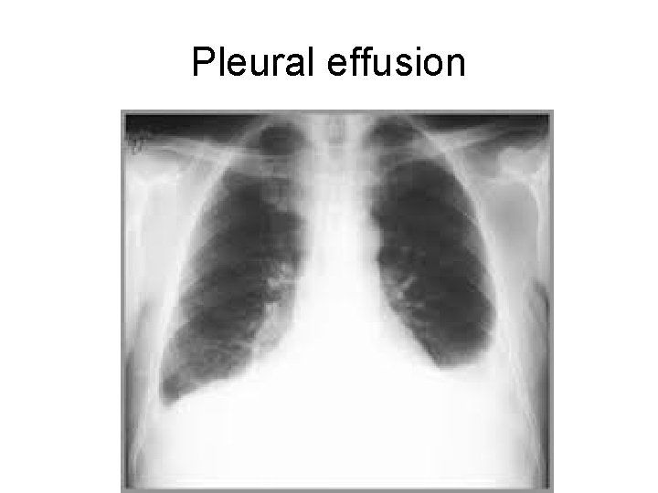 Pleural effusion 