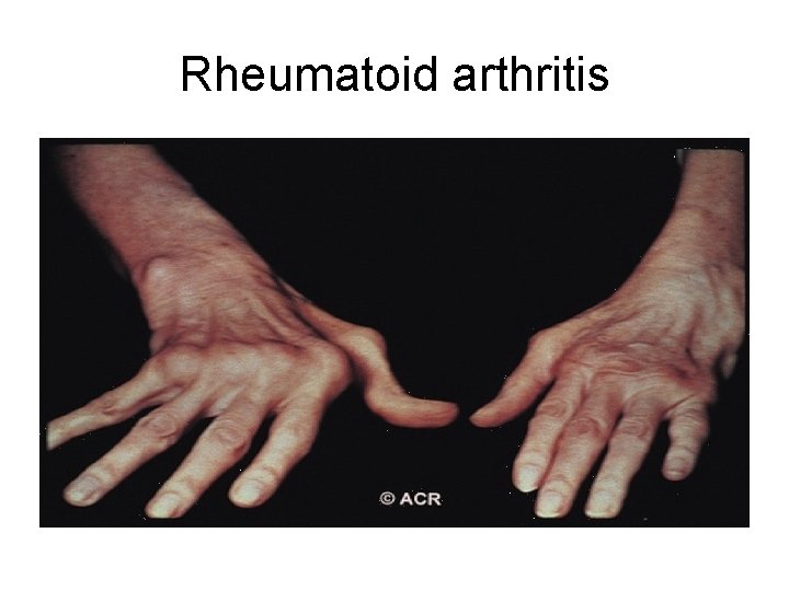 Rheumatoid arthritis 