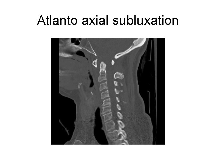 Atlanto axial subluxation 