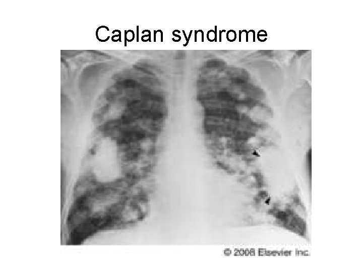 Caplan syndrome 