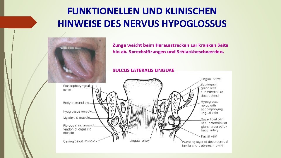 FUNKTIONELLEN UND KLINISCHEN HINWEISE DES NERVUS HYPOGLOSSUS Zunge weicht beim Herausstrecken zur kranken Seite
