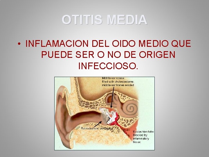 OTITIS MEDIA • INFLAMACION DEL OIDO MEDIO QUE PUEDE SER O NO DE ORIGEN