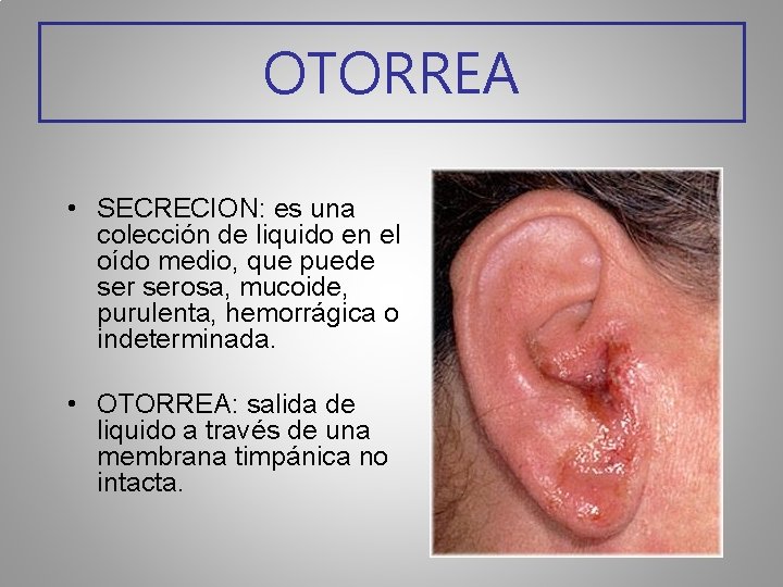 OTORREA • SECRECION: es una colección de liquido en el oído medio, que puede