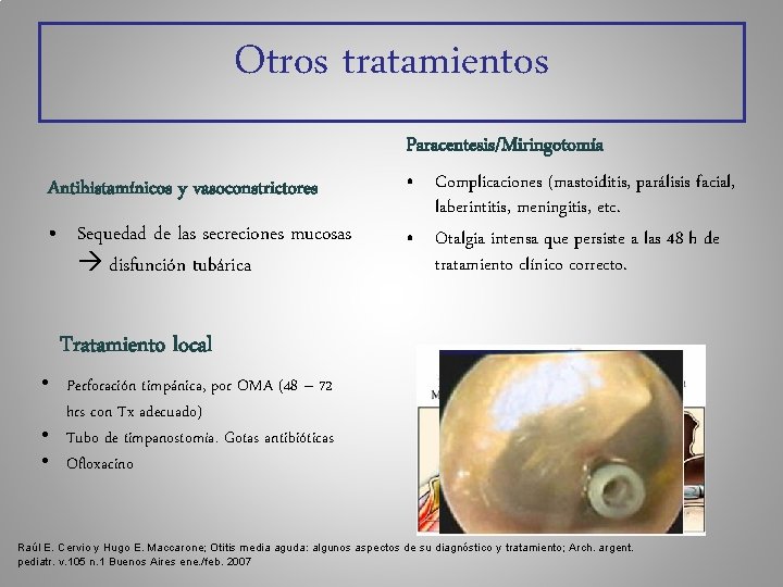 Otros tratamientos Paracentesis/Miringotomía Antihistamínicos y vasoconstrictores • Sequedad de las secreciones mucosas disfunción tubárica