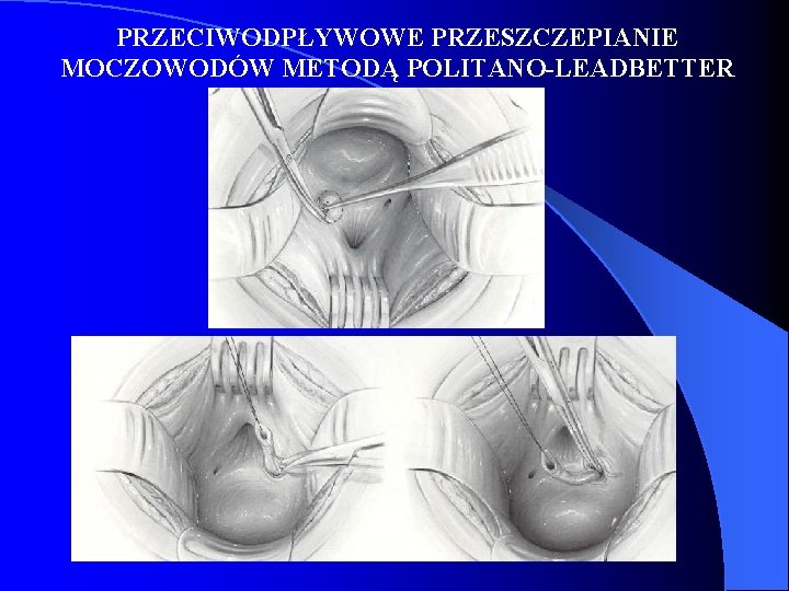 PRZECIWODPŁYWOWE PRZESZCZEPIANIE MOCZOWODÓW METODĄ POLITANO-LEADBETTER 