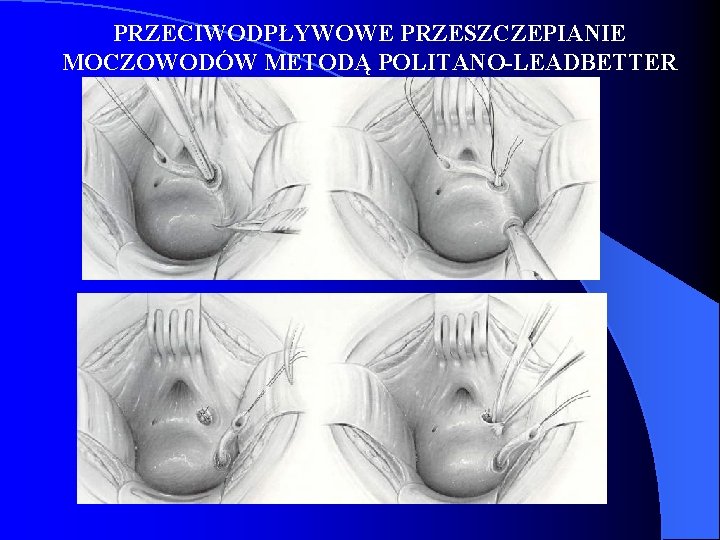 PRZECIWODPŁYWOWE PRZESZCZEPIANIE MOCZOWODÓW METODĄ POLITANO-LEADBETTER PRZECIWODPŁYWOWE PRZESZCZEPIANIE MOCZOWODÓW METODĄ POLITANO-LEADBETTER
