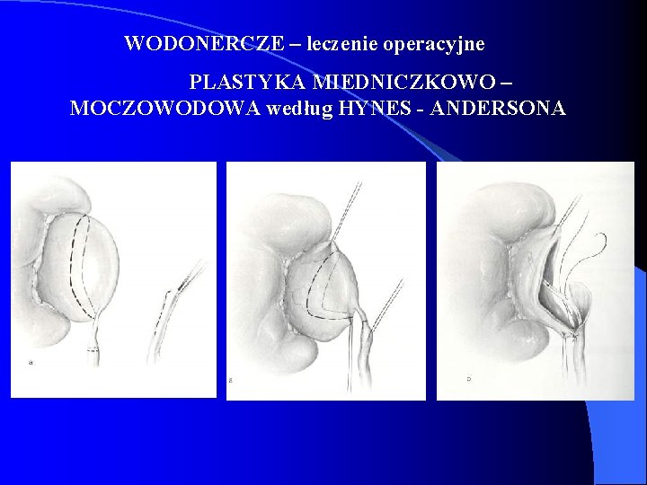 WODONERCZE – leczenie operacyjne PLASTYKA MIEDNICZKOWO – MOCZOWODOWA według HYNES - ANDERSONA 