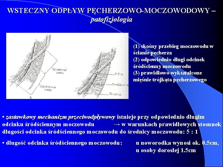 WSTECZNY ODPŁYW PĘCHERZOWO-MOCZOWODOWY – patofizjologia (1) skośny przebieg moczowodu w ścianie pęcherza (2) odpowiednio