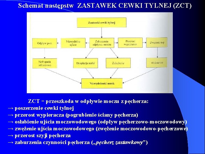 Schemat następstw ZASTAWEK CEWKI TYLNEJ (ZCT) ZCT = przeszkoda w odpływie moczu z pęcherza: Schemat następstw ZASTAWEK CEWKI TYLNEJ (ZCT) ZCT = przeszkoda w odpływie moczu z pęcherza: