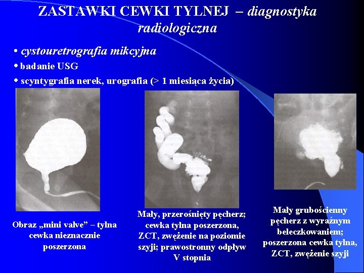ZASTAWKI CEWKI TYLNEJ – diagnostyka radiologiczna • cystouretrografia mikcyjna • badanie USG • scyntygrafia ZASTAWKI CEWKI TYLNEJ – diagnostyka radiologiczna • cystouretrografia mikcyjna • badanie USG • scyntygrafia