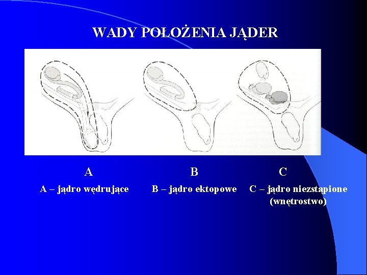 WADY POŁOŻENIA JĄDER A A – jądro wędrujące B B – jądro ektopowe C WADY POŁOŻENIA JĄDER A A – jądro wędrujące B B – jądro ektopowe C
