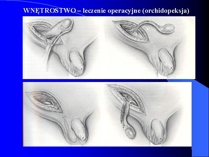WNĘTROSTWO – leczenie operacyjne (orchidopeksja) WNĘTROSTWO – leczenie operacyjne (orchidopeksja)