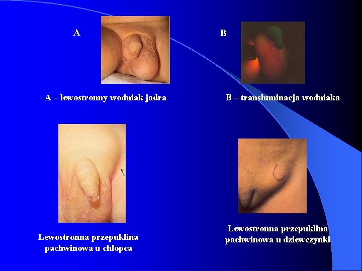 A A – lewostronny wodniak jadra Lewostronna przepuklina pachwinowa u chłopca B B – A A – lewostronny wodniak jadra Lewostronna przepuklina pachwinowa u chłopca B B –