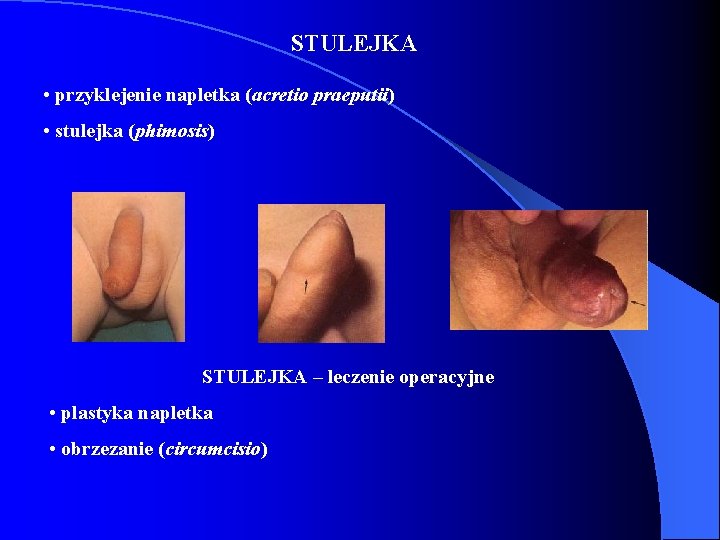 STULEJKA • przyklejenie napletka (acretio praeputii) • stulejka (phimosis) STULEJKA – leczenie operacyjne •
