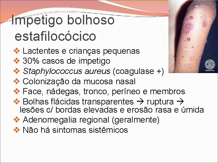 Impetigo bolhoso estafilocócico v Lactentes e crianças pequenas v 30% casos de impetigo v Impetigo bolhoso estafilocócico v Lactentes e crianças pequenas v 30% casos de impetigo v
