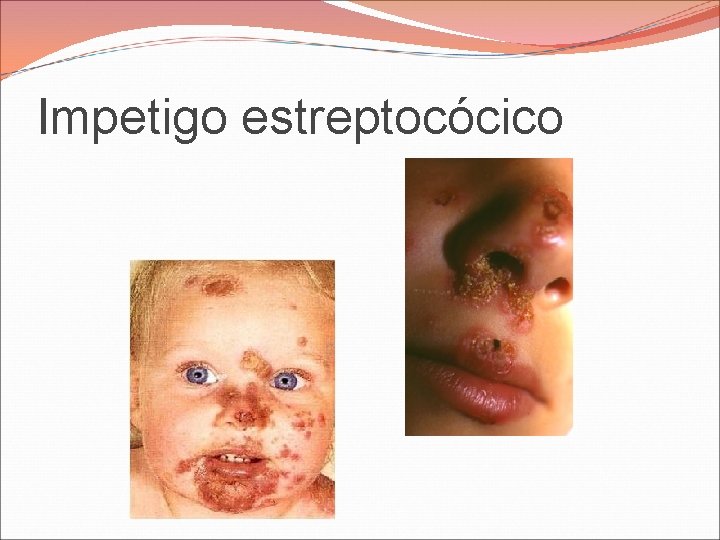 Impetigo estreptocócico Impetigo estreptocócico