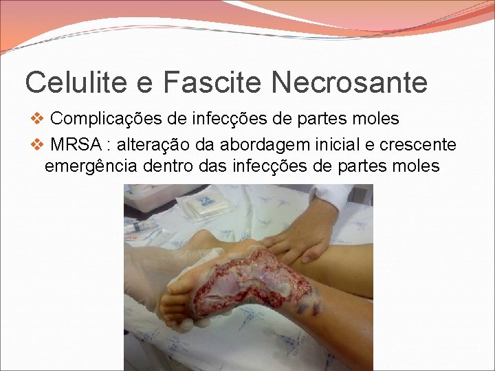 Celulite e Fascite Necrosante v Complicações de infecções de partes moles v MRSA : Celulite e Fascite Necrosante v Complicações de infecções de partes moles v MRSA :