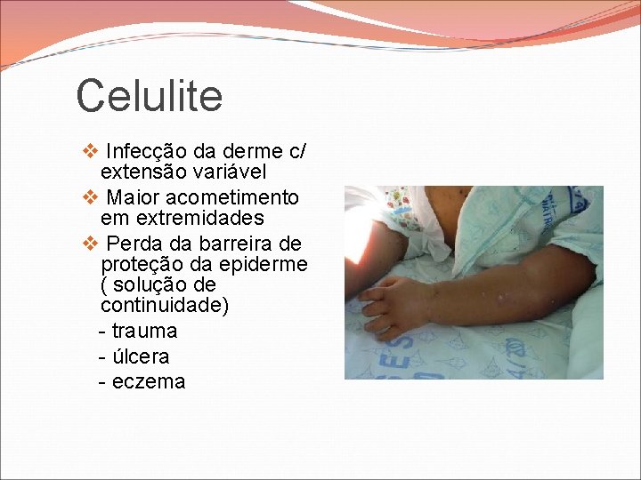 Celulite v Infecção da derme c/ extensão variável v Maior acometimento em extremidades v Celulite v Infecção da derme c/ extensão variável v Maior acometimento em extremidades v