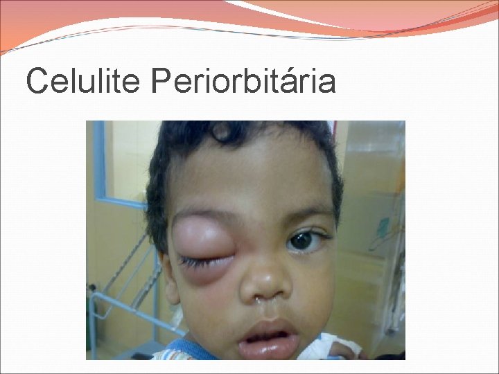 Celulite Periorbitária Celulite Periorbitária