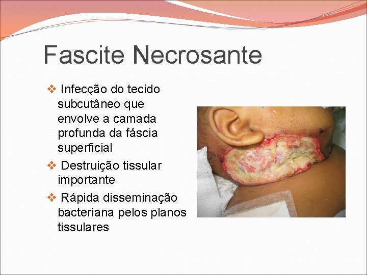 Fascite Necrosante v Infecção do tecido subcutâneo que envolve a camada profunda da fáscia Fascite Necrosante v Infecção do tecido subcutâneo que envolve a camada profunda da fáscia