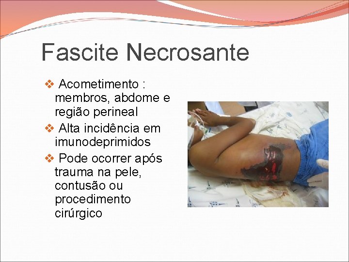 Fascite Necrosante v Acometimento : membros, abdome e região perineal v Alta incidência em Fascite Necrosante v Acometimento : membros, abdome e região perineal v Alta incidência em