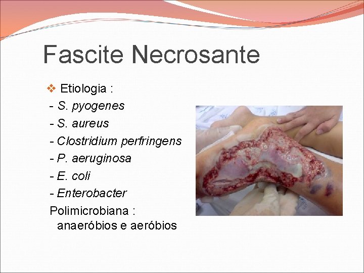 Fascite Necrosante v Etiologia : - S. pyogenes - S. aureus - Clostridium perfringens Fascite Necrosante v Etiologia : - S. pyogenes - S. aureus - Clostridium perfringens