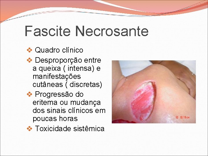 Fascite Necrosante v Quadro clínico v Desproporção entre a queixa ( intensa) e manifestações Fascite Necrosante v Quadro clínico v Desproporção entre a queixa ( intensa) e manifestações