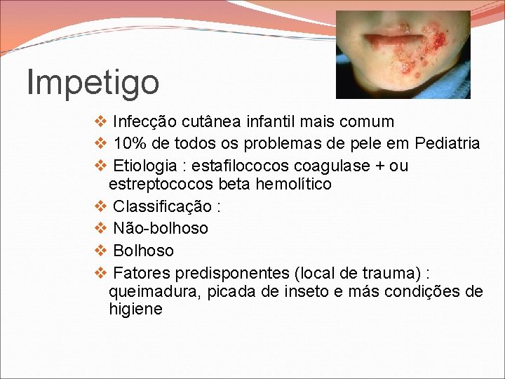 Impetigo v Infecção cutânea infantil mais comum v 10% de todos os problemas de Impetigo v Infecção cutânea infantil mais comum v 10% de todos os problemas de