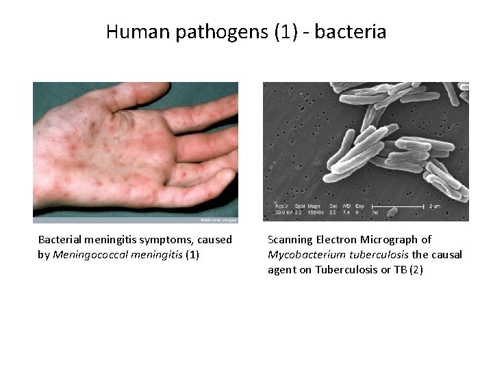 Human pathogens (1) - bacteria Bacterial meningitis symptoms, caused by Meningococcal meningitis (1) Scanning