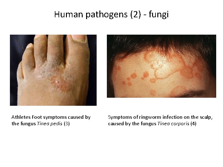 Human pathogens (2) - fungi Athletes Foot symptoms caused by the fungus Tinea pedis