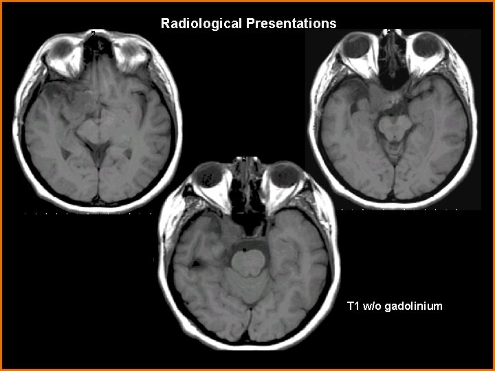 Radiological Presentations T 1 w/o gadolinium 