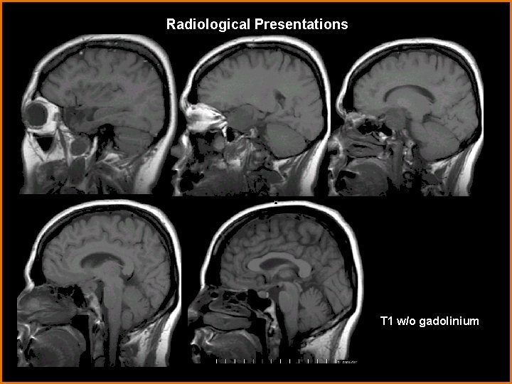 Radiological Presentations T 1 w/o gadolinium 