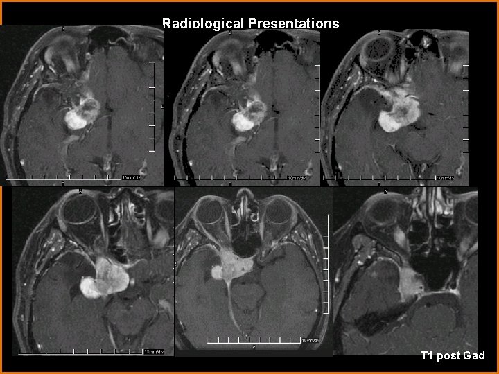 Radiological Presentations T 1 post Gad 