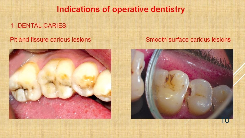 Indications of operative dentistry 1. DENTAL CARIES Pit and fissure carious lesions Smooth surface