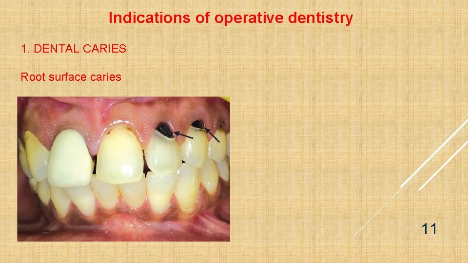 Indications of operative dentistry 1. DENTAL CARIES Root surface caries 11 