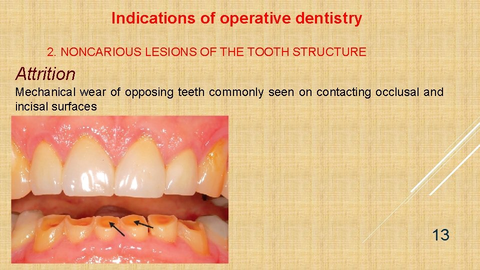 Indications of operative dentistry 2. NONCARIOUS LESIONS OF THE TOOTH STRUCTURE Attrition Mechanical wear