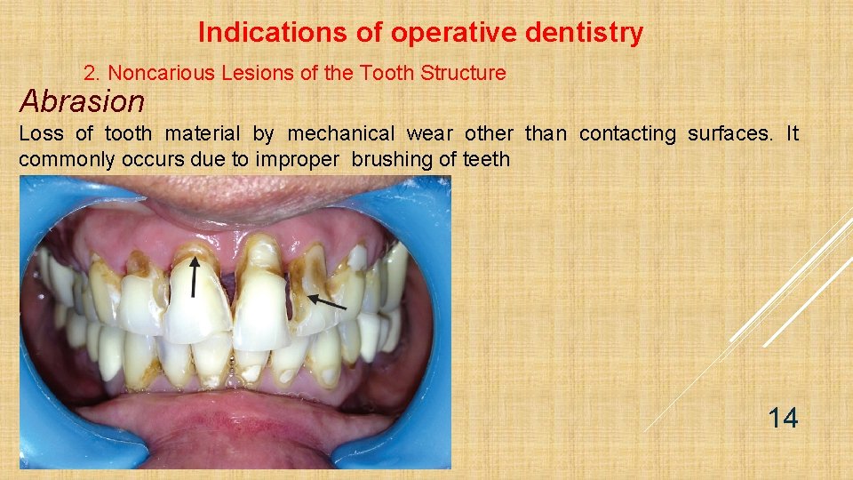 Indications of operative dentistry 2. Noncarious Lesions of the Tooth Structure Abrasion Loss of